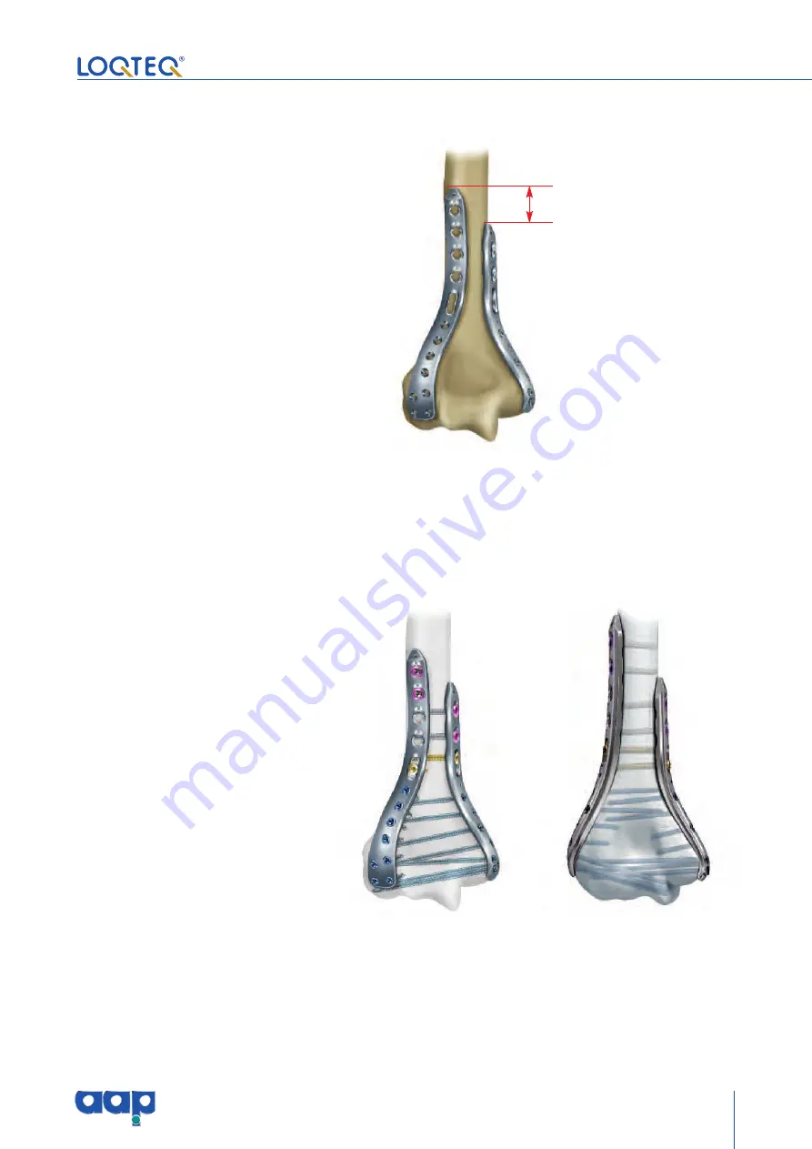 AAP LOQTEQ Distal Dorsolateral Humerus Plate... Скачать руководство пользователя страница 11