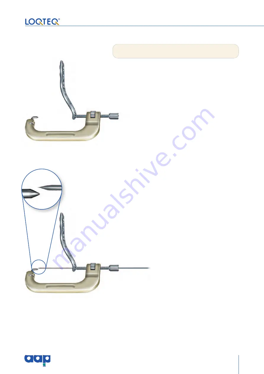 AAP LOQTEQ Distal Dorsolateral Humerus Plate... Скачать руководство пользователя страница 15