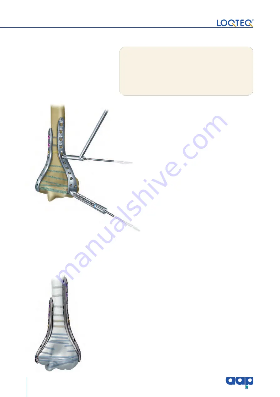 AAP LOQTEQ Distal Dorsolateral Humerus Plate... Скачать руководство пользователя страница 20