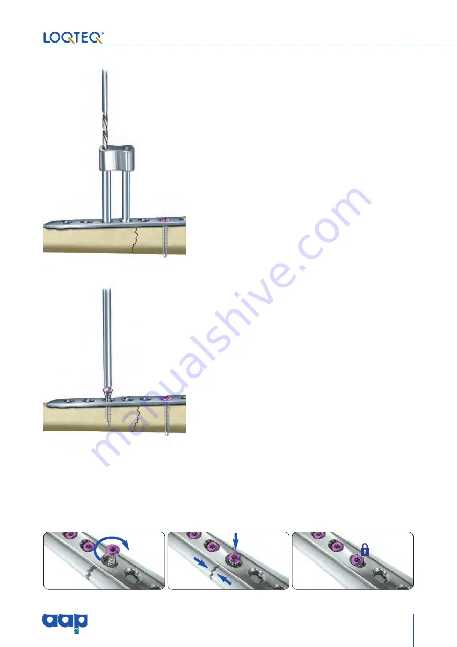 AAP LOQTEQ Distal Dorsolateral Humerus Plate... Скачать руководство пользователя страница 27