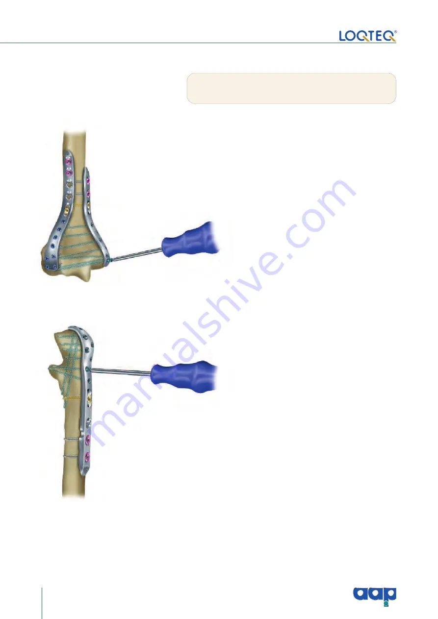 AAP LOQTEQ Distal Dorsolateral Humerus Plate... Скачать руководство пользователя страница 28