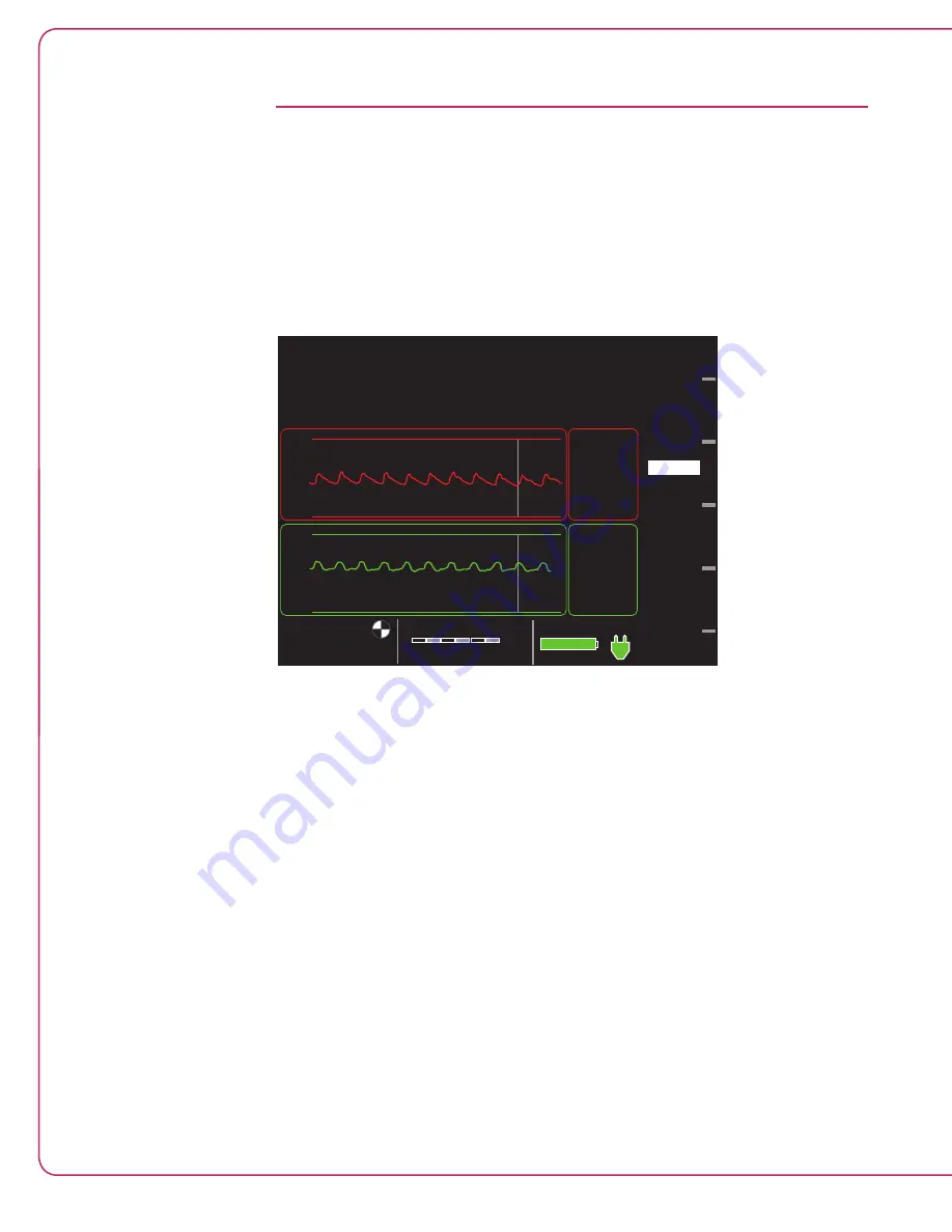 Abiomed Impella RP Instructions For Use & Clinical Reference Manual Download Page 33