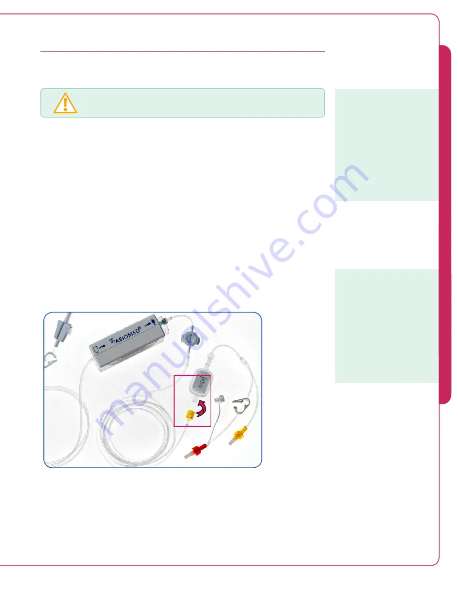 Abiomed Impella RP Instructions For Use & Clinical Reference Manual Download Page 52