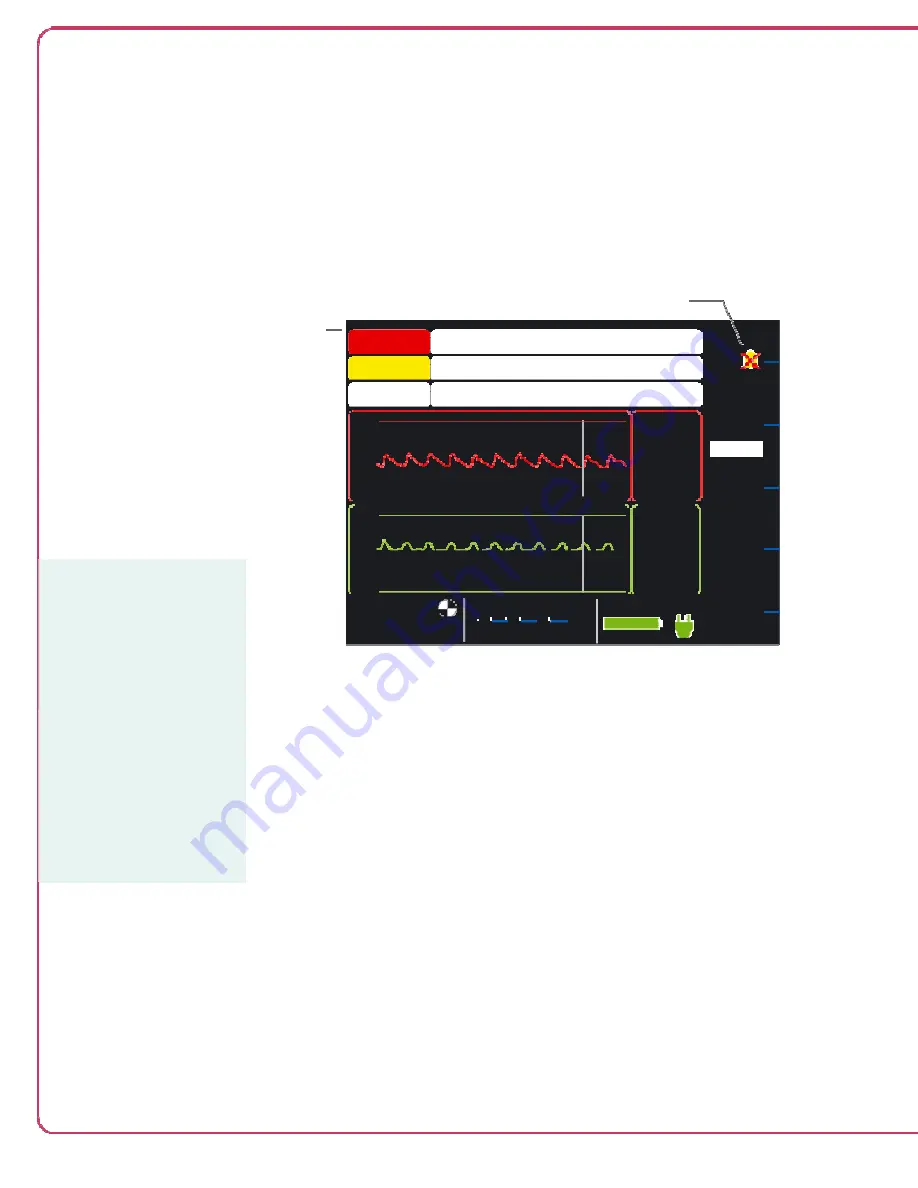 Abiomed Impella RP Instructions For Use & Clinical Reference Manual Download Page 72