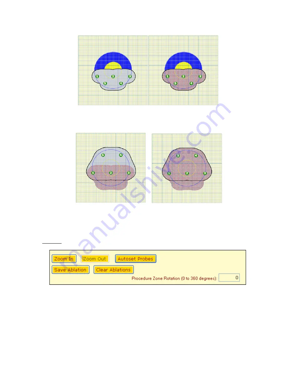 AngioDynamics NanoKnife User Manual Download Page 51