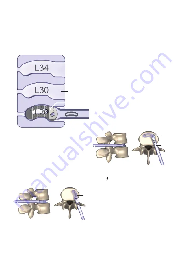 Braun Aesculap TSPACE PEEK Instructions For Use/Technical Description Download Page 49