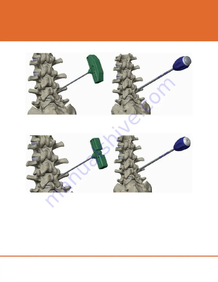 CAMBER ORTHROS MIS Surgical Technique Manual Download Page 6