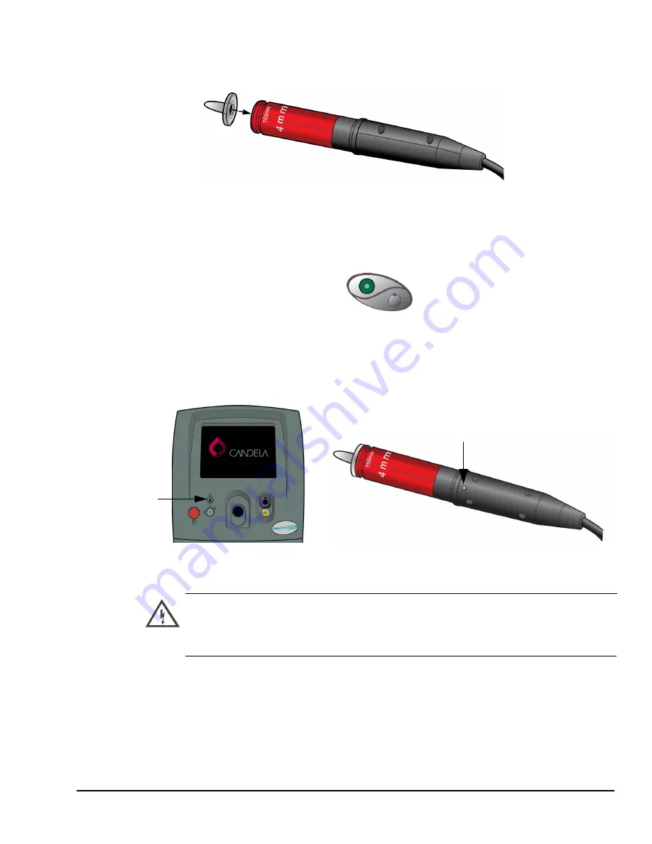 Candela AlexTriVantage Operator'S Manual Download Page 73