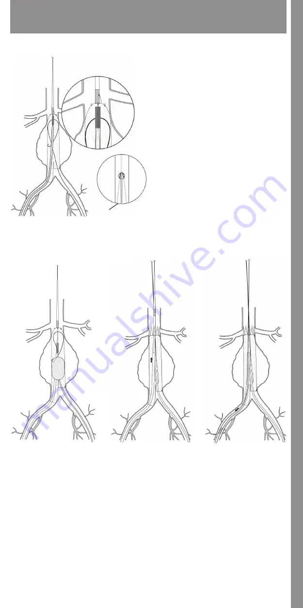 COOK Medical Zenith Flex Скачать руководство пользователя страница 19