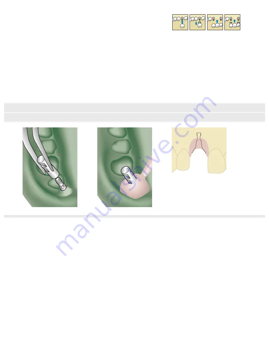 Dentsply Sirona Ankylos Balance Base Abutment C Скачать руководство пользователя страница 35