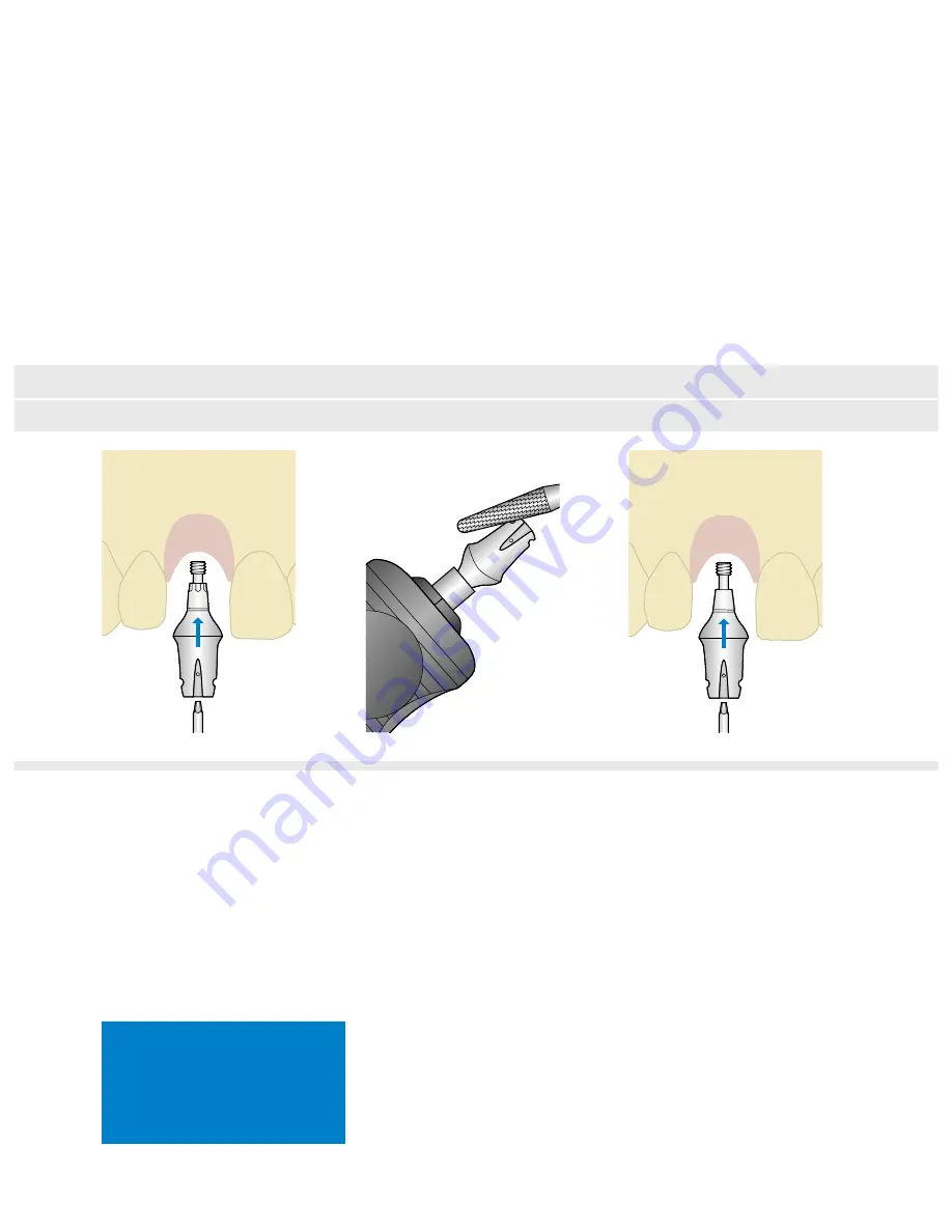 Dentsply Sirona Ankylos Balance Base Abutment C Скачать руководство пользователя страница 36