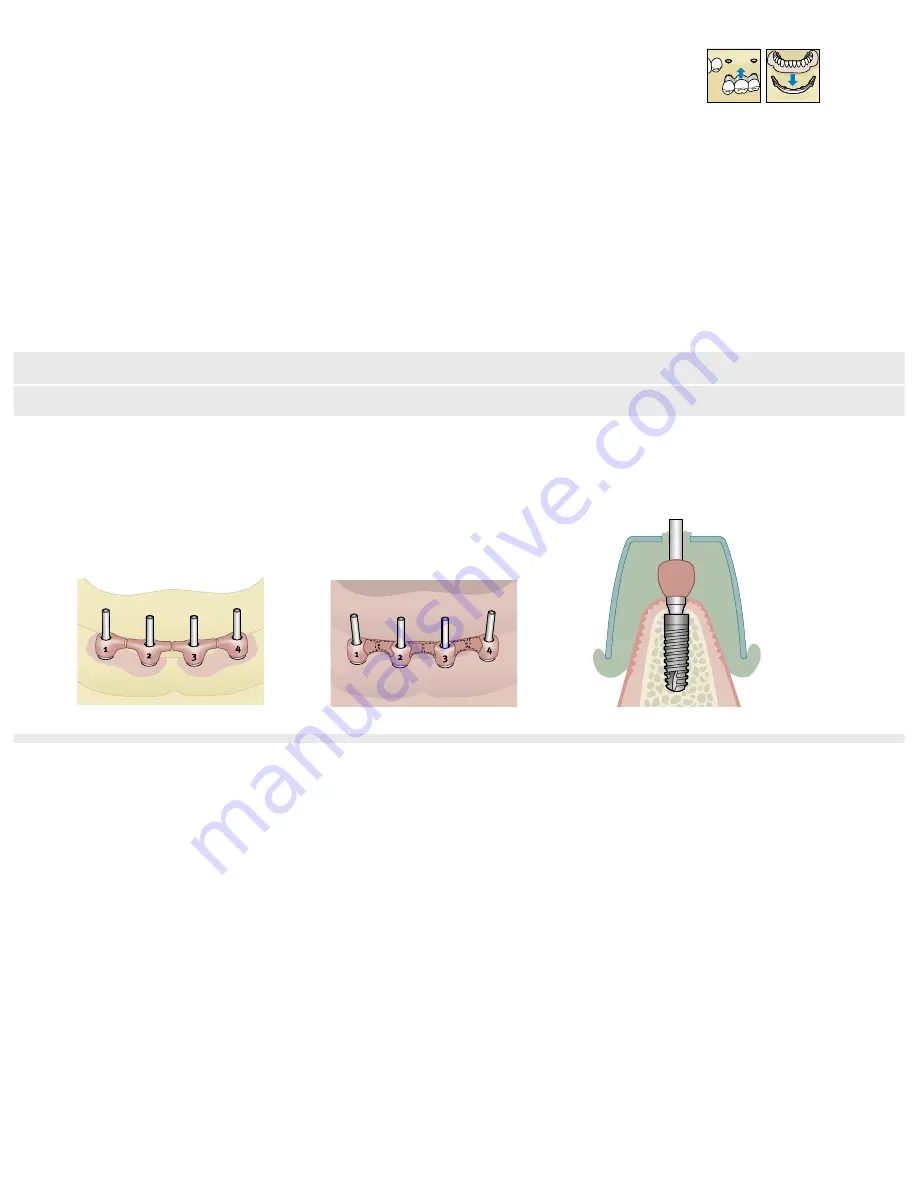 Dentsply Sirona Ankylos Balance Base Abutment C Скачать руководство пользователя страница 61