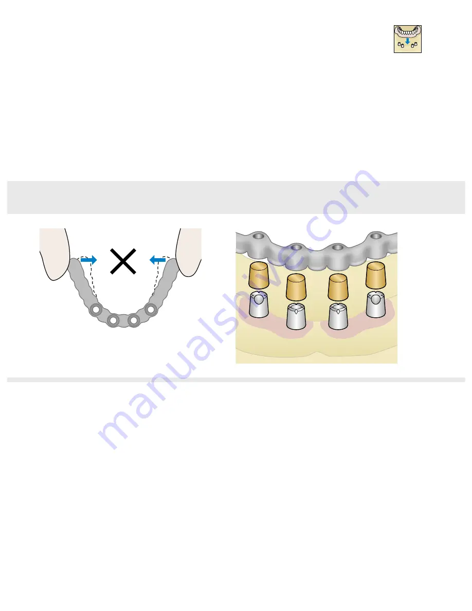 Dentsply Sirona Ankylos Balance Base Abutment C Скачать руководство пользователя страница 77