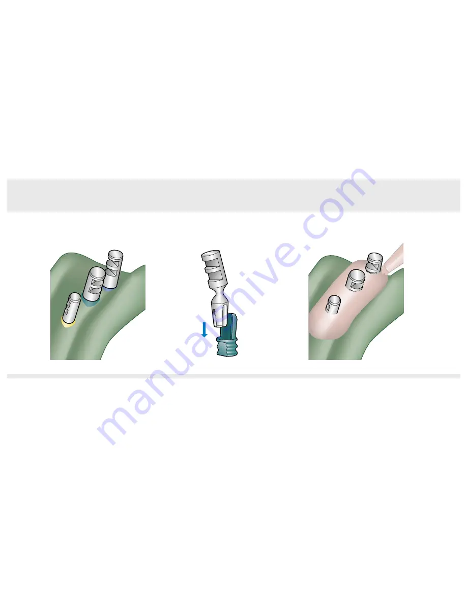 Dentsply Sirona Ankylos Balance Base Abutment C Laboratory Manual Download Page 90