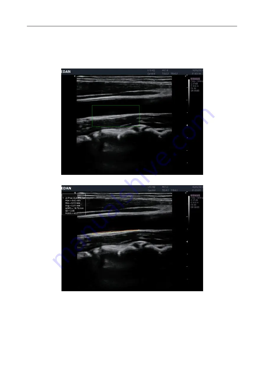 EDAN Acclarix AX4 User Manual Download Page 87