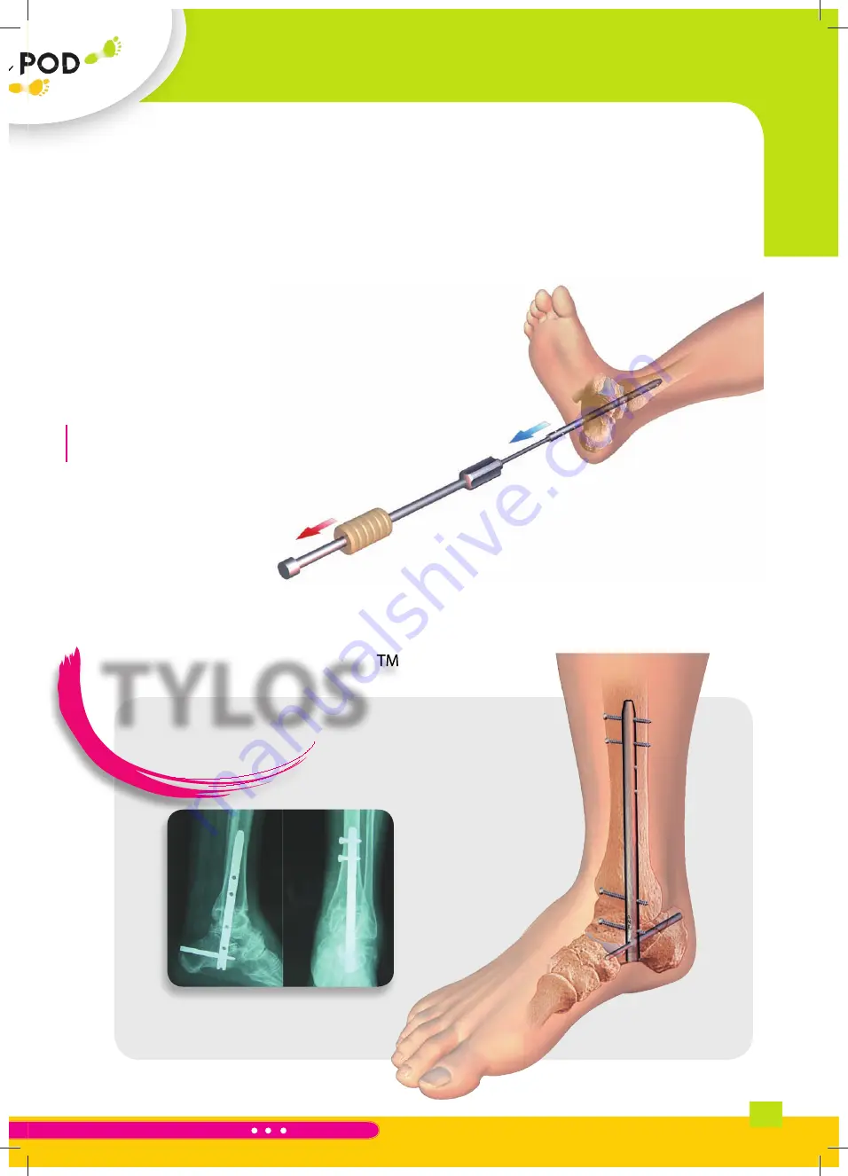 FH ORTHOPEDICS be POD TYLOS Arthrodese-Nail Manual Download Page 7