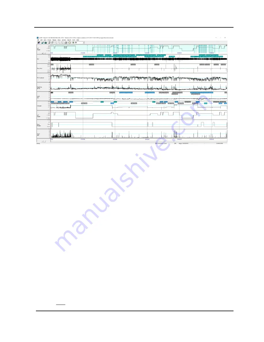 Itamar Medical WatchPAT Operation Manual Download Page 16