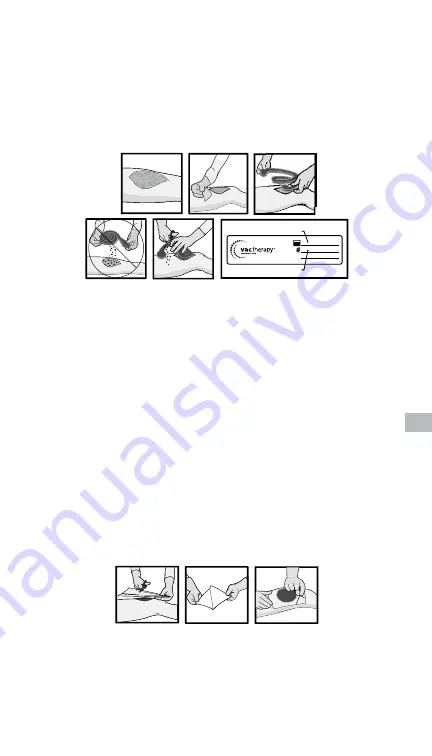 KCI V.A.C.Via v.a.c.therapy Negative Pressure Wound Therapy... Instructions For Use Manual Download Page 203