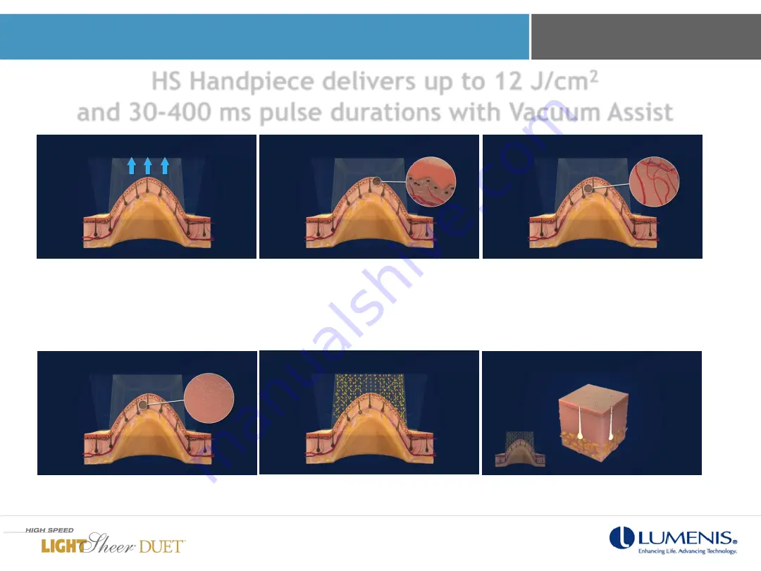 LUMENIS LightSheer Duet In-Servicing Training Download Page 40