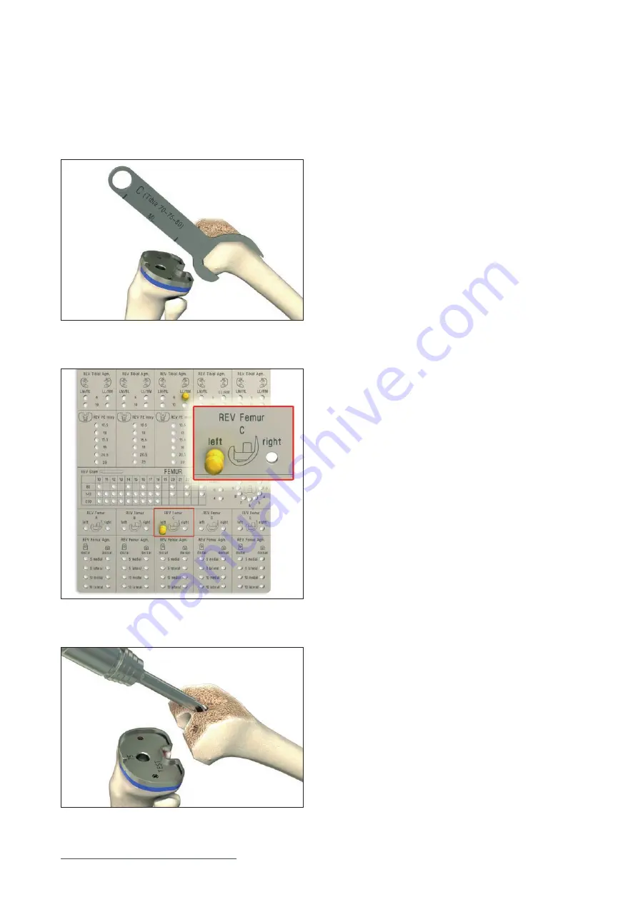 Mathys balanSys REV Surgical Techniques Download Page 24