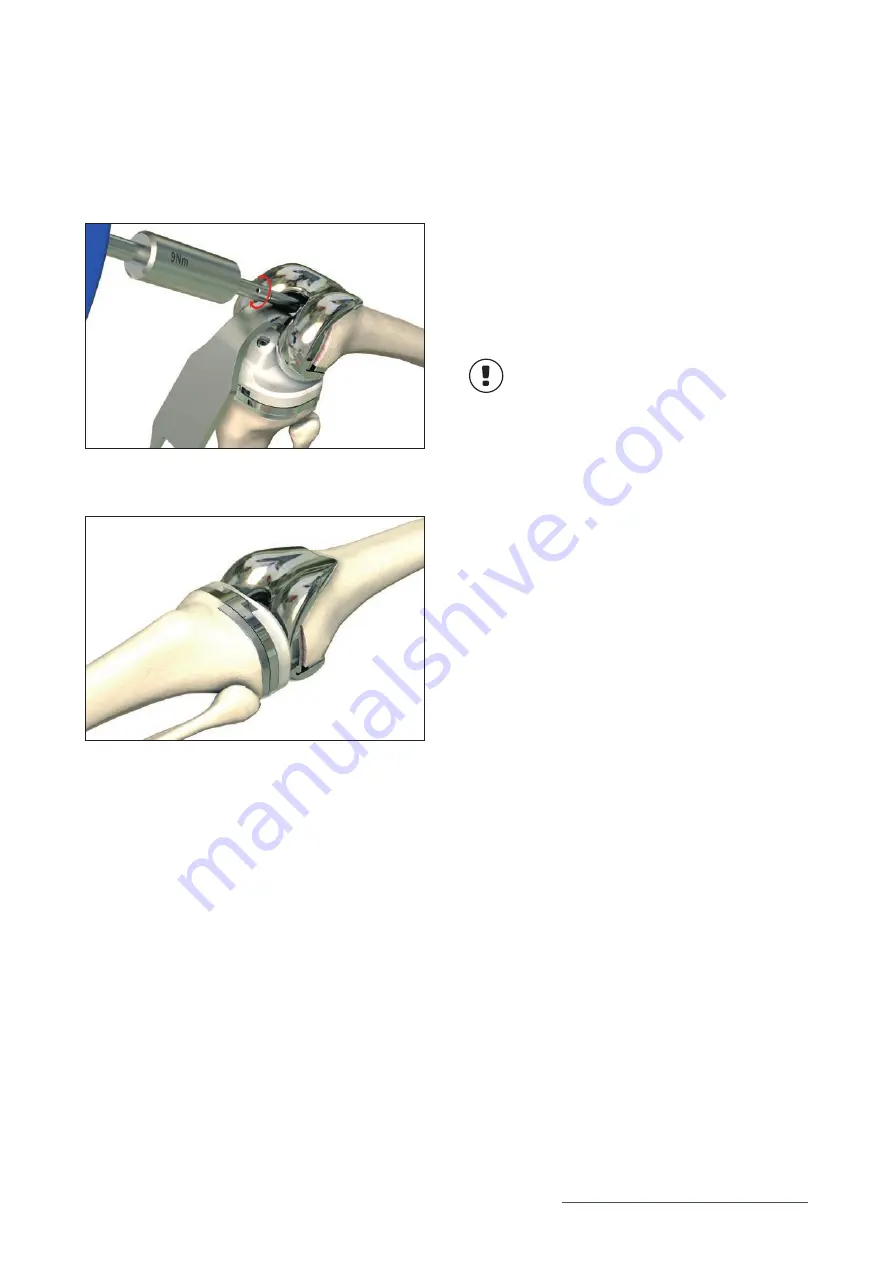 Mathys balanSys REV Surgical Techniques Download Page 57