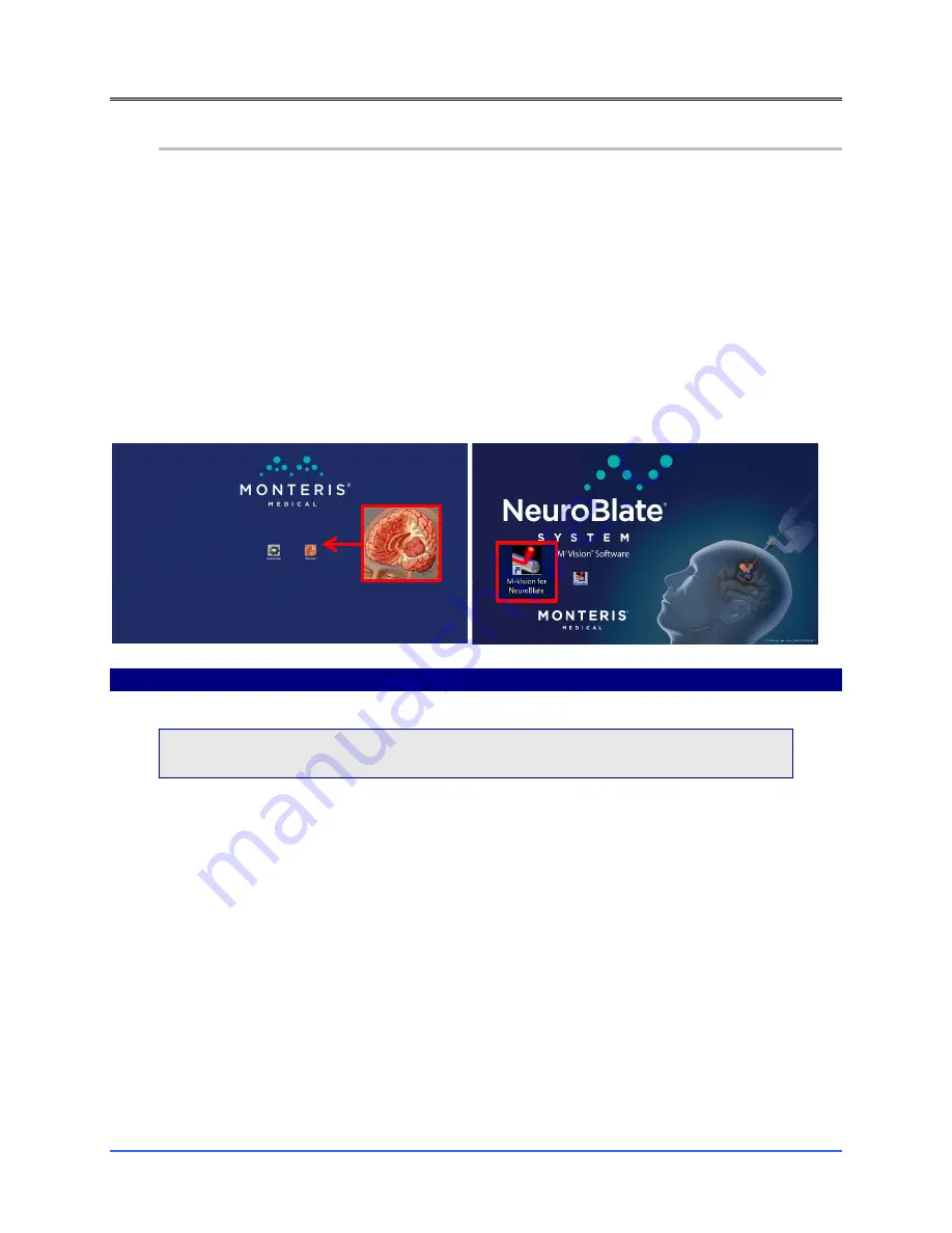 Monteris Medical Neuroblate Instructions For Use Manual Download Page 48