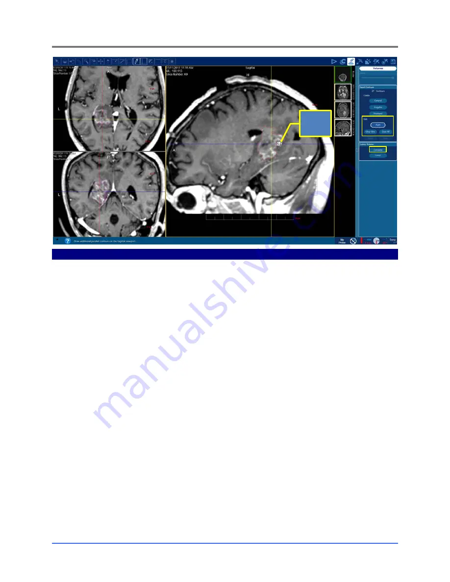 Monteris Medical Neuroblate Instructions For Use Manual Download Page 62