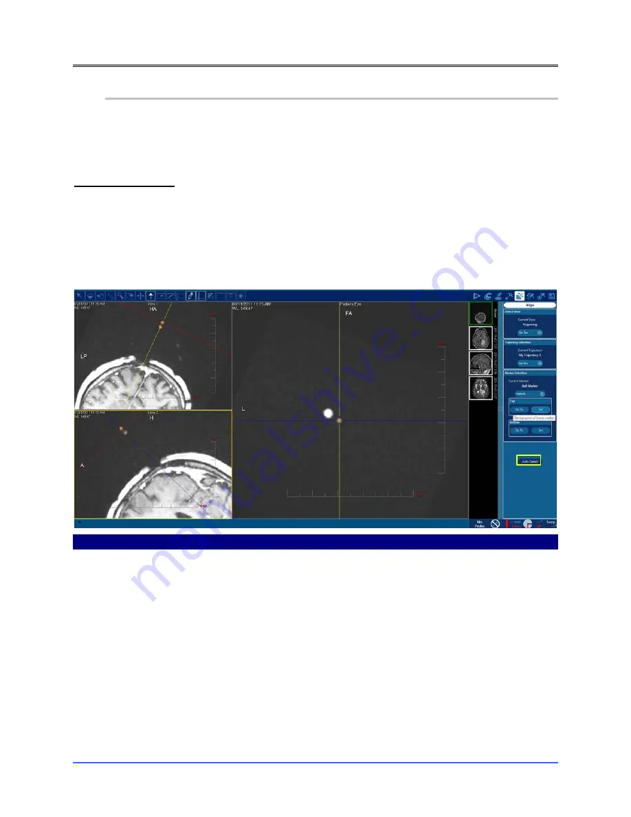 Monteris Medical Neuroblate Instructions For Use Manual Download Page 88