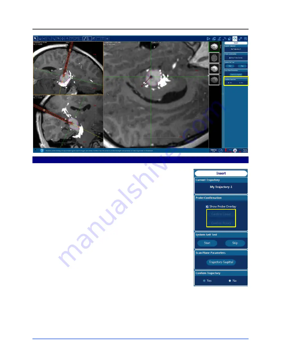 Monteris Medical Neuroblate Instructions For Use Manual Download Page 112