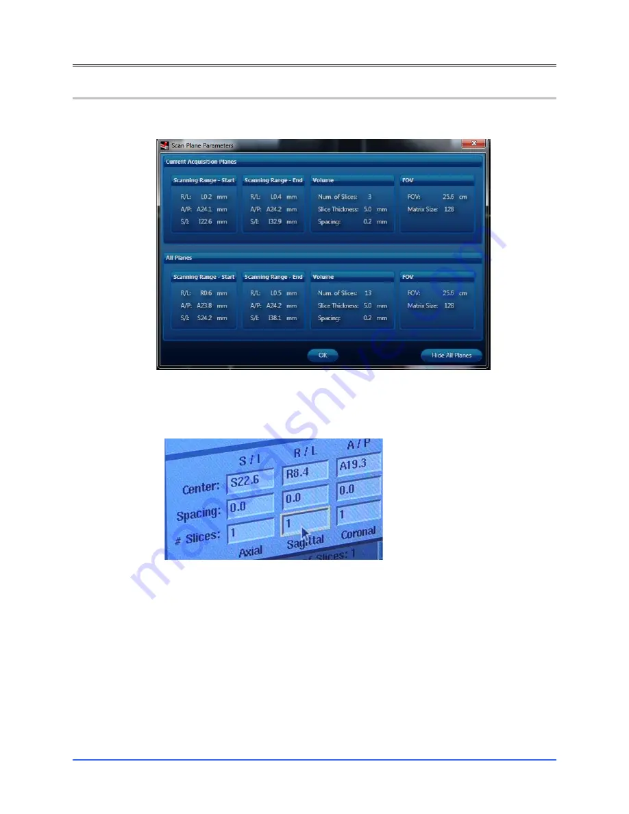 Monteris Medical Neuroblate Instructions For Use Manual Download Page 125