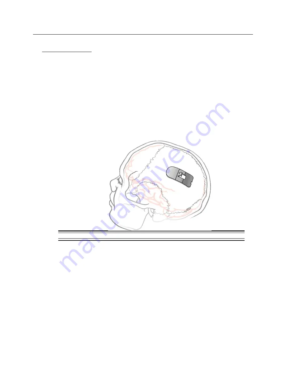 Neuropace NeuroPace CL-315-10 User Manual Download Page 42