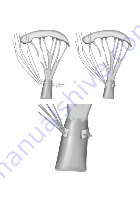 On-X Chord-X Series Instructions For Use Manual Download Page 84