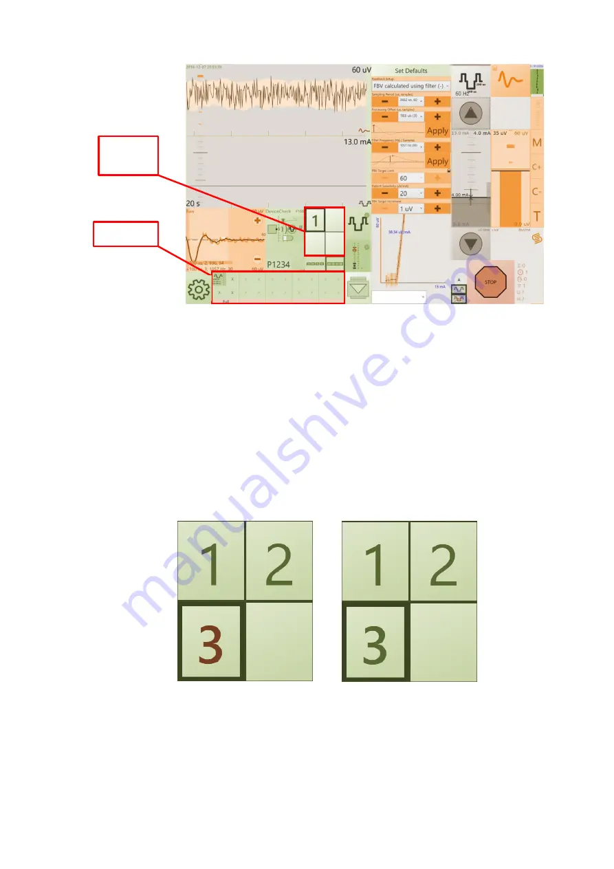 SALUDA MEDICAL Evoke Clinical Manual Download Page 32