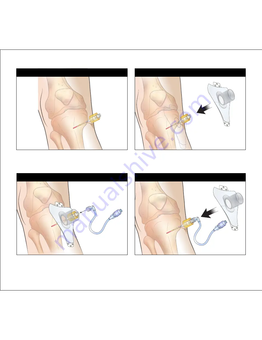 SAM MEDICAL IO Stabilizer Instructions For Use Manual Download Page 6