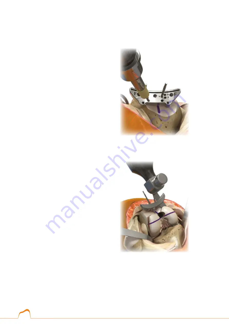 Smith & Nephew Syncera Anthem Surgical Techniques Download Page 8