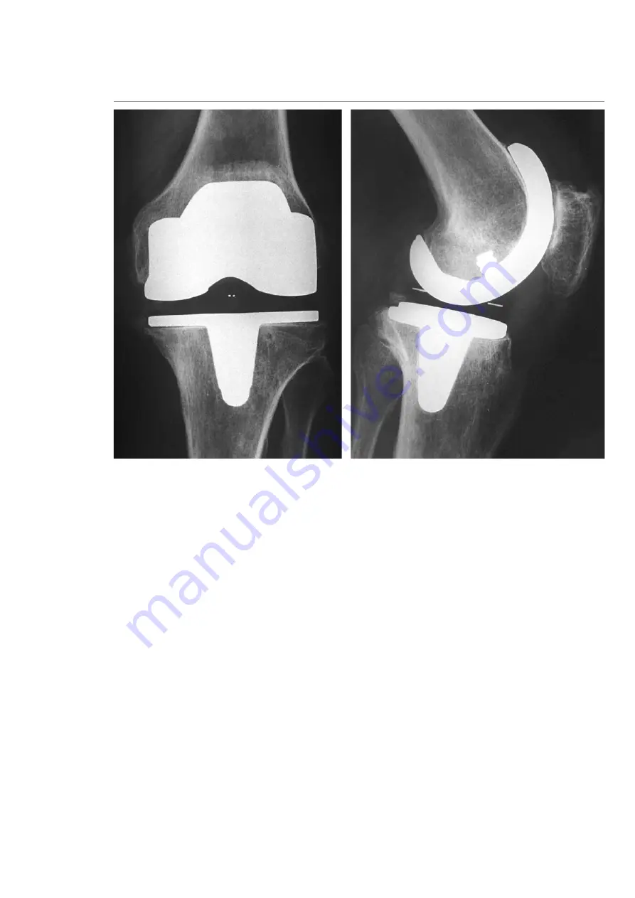 Smith & Nephew TC-PLUS Revision Surgical Technique Download Page 12