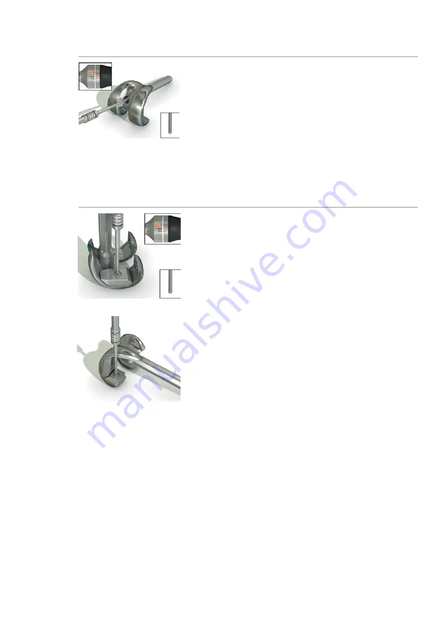 Smith & Nephew TC-PLUS Revision Surgical Technique Download Page 52