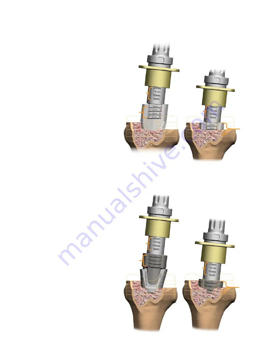 smith&nephew LEGION Cones Surgical Technique Download Page 20