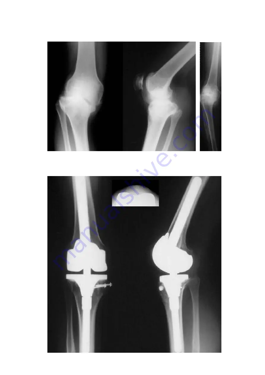 smith&nephew RT-PLUS Surgical Technique Download Page 11