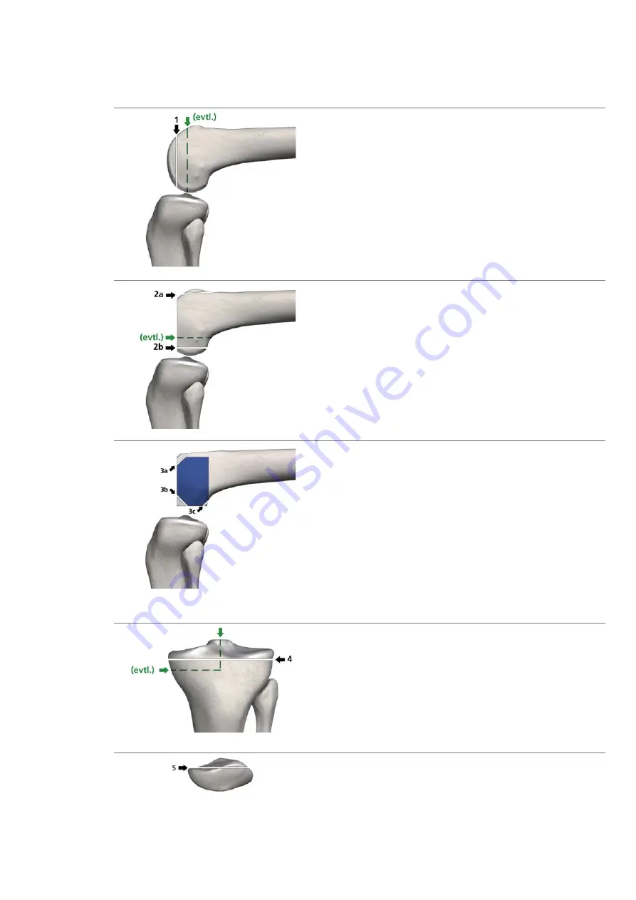 smith&nephew RT-PLUS Surgical Technique Download Page 16