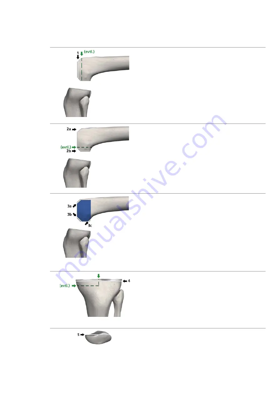 smith&nephew RT-PLUS Surgical Technique Download Page 17