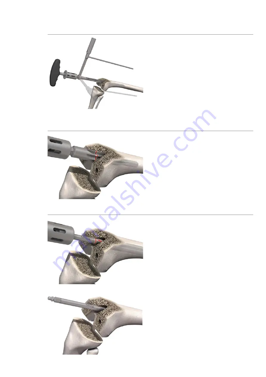 smith&nephew RT-PLUS Surgical Technique Download Page 21