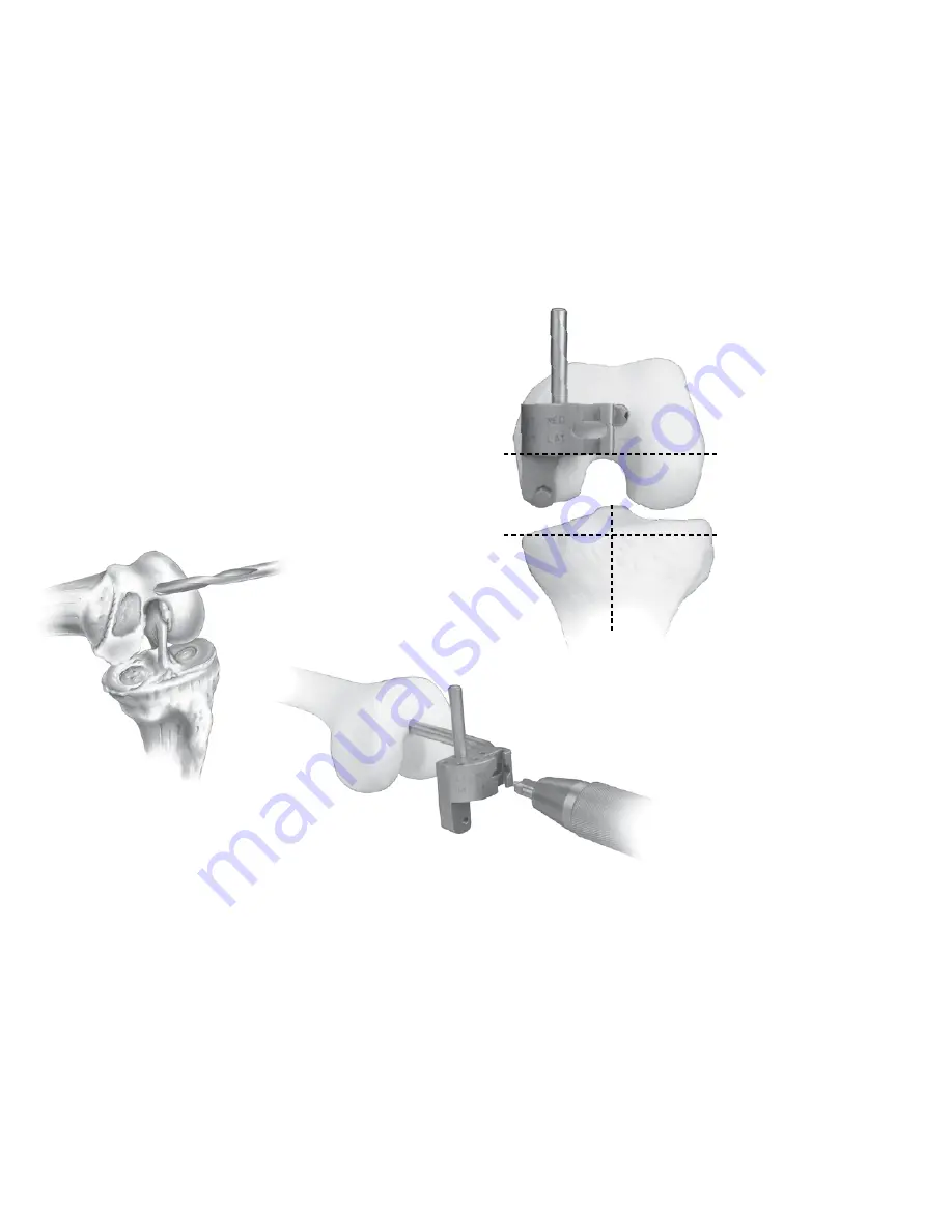 smith&nephew ZUK Surgical Techniques Download Page 8