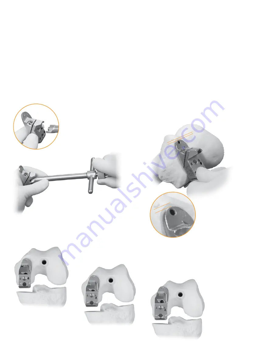 smith&nephew ZUK Surgical Techniques Download Page 14