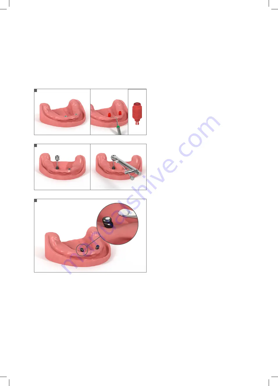 Straumann Novaloc Technical Information Download Page 4