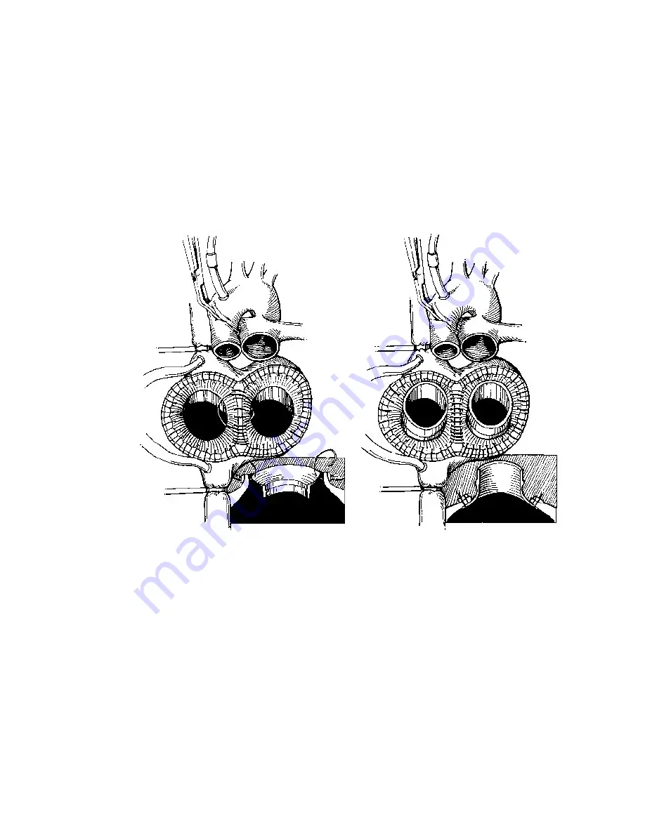 SynCardia TAH-t Instructions For Use Manual Download Page 14