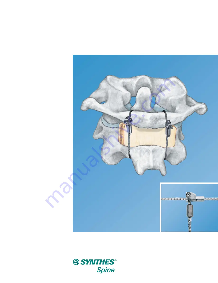 Synthes Spine Cable System Скачать руководство пользователя страница 1