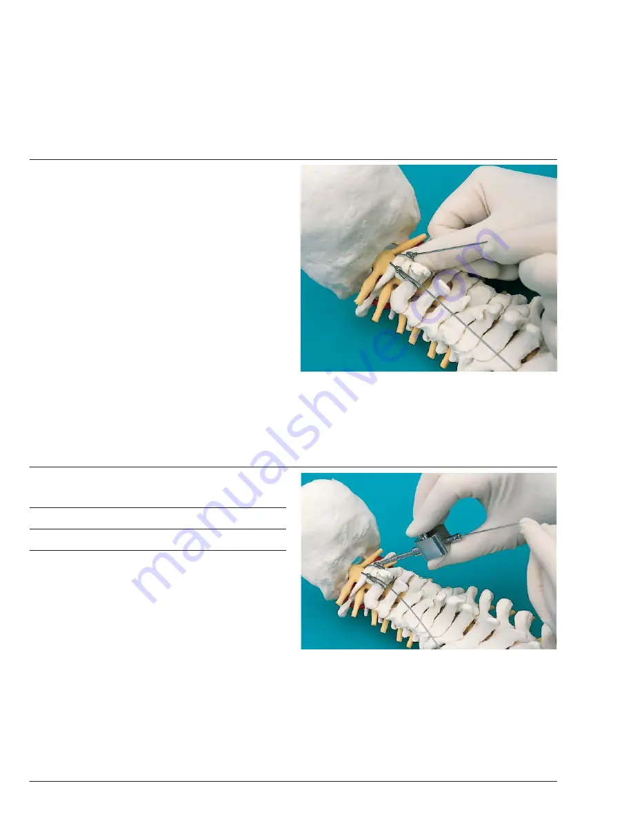 Synthes Spine Cable System Technical Manual Download Page 8