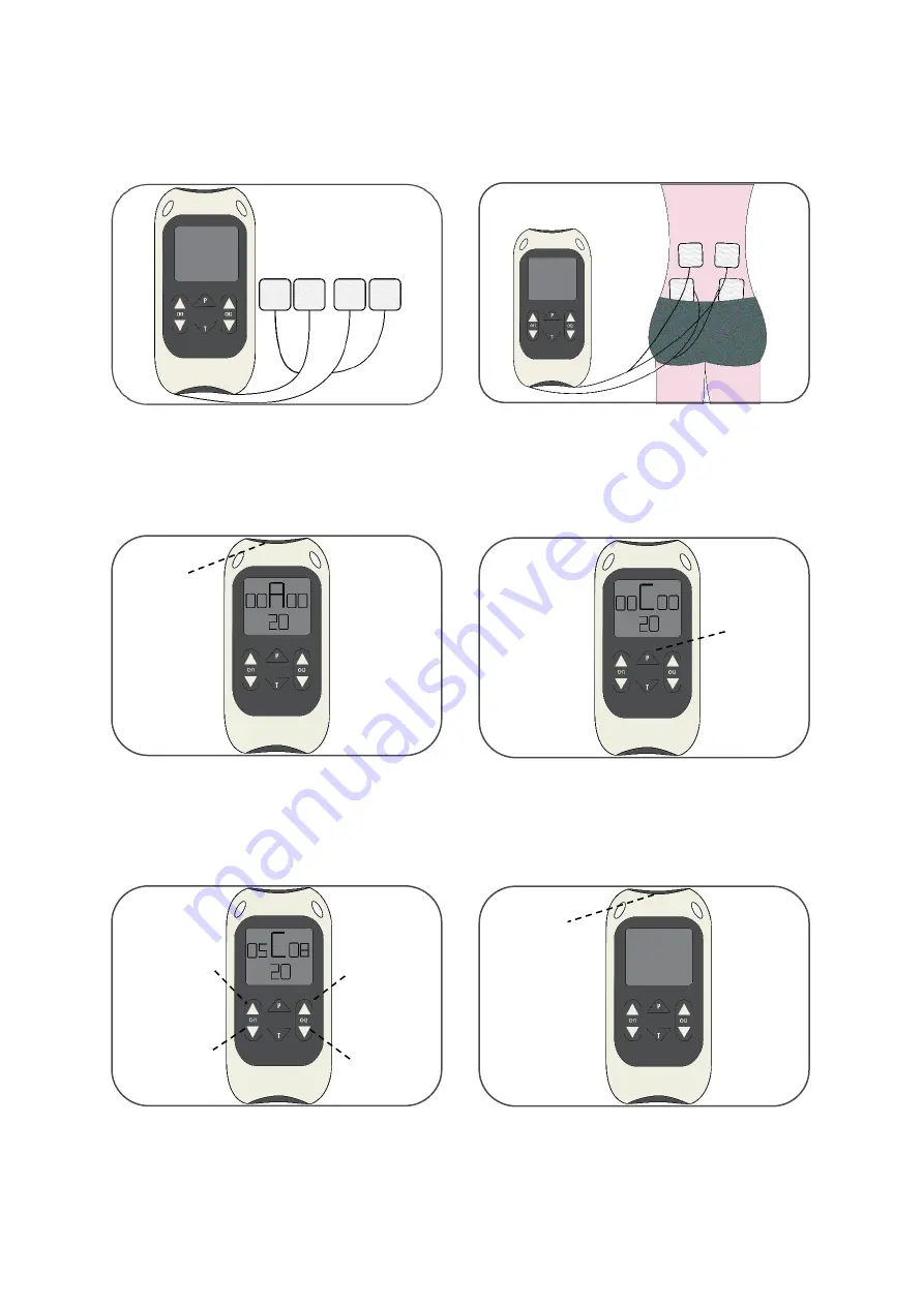 TensCare Perfect EMS Instructions For Use Manual Download Page 2