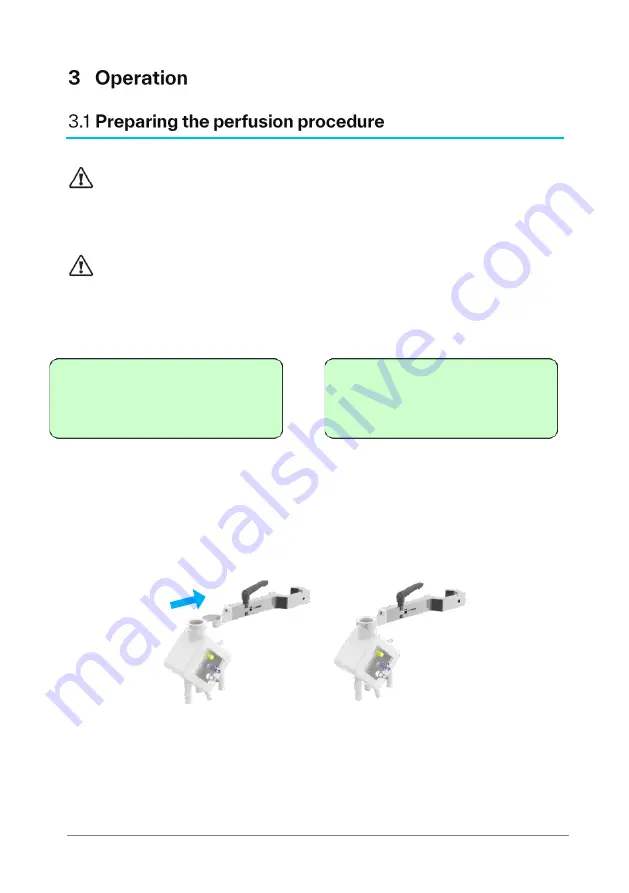 XVIVO Liver Assist Instructions For Use Manual Download Page 15